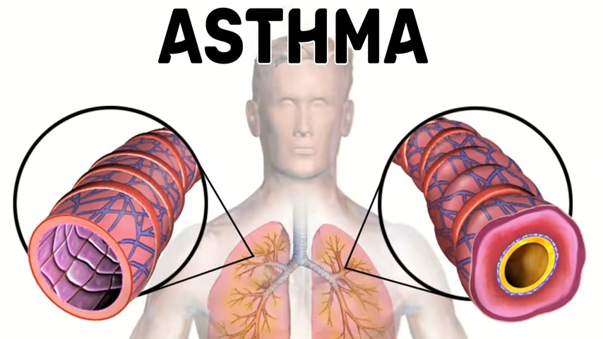 Understanding and Managing Asthma A Comprehensive Guide